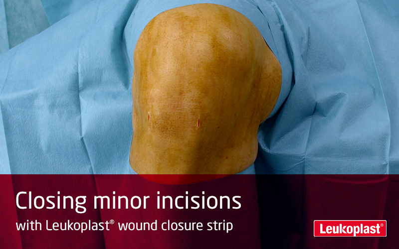 This video shows how to treat cut wounds with Leukoplast wound closure strip: we see the hands of an HCP using wound closure strips to close two minor incisions on a knee. This video shows how to treat cut wounds with Leukoplast wound closure strip: we see the hands of an HCP using wound closure strips to close two minor incisions on a knee.